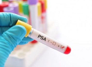 Как измеряют ПСА крови и какие показатели при аденоме простаты